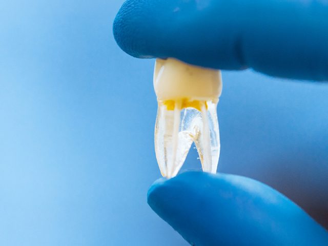 Endodontics https://thedentalbartt.com/quoviz_storage/2024/12/Endodontics-640x480.jpg